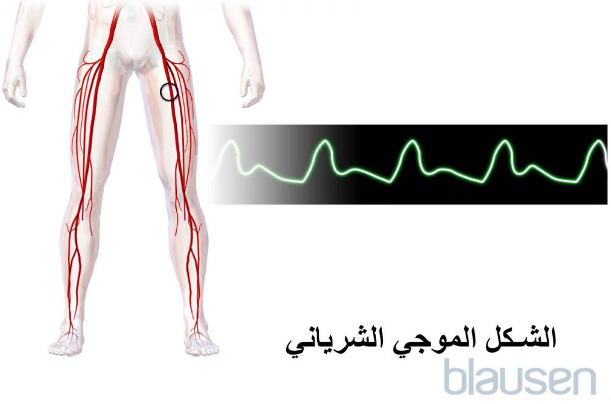 الشكل الموجي الشرياني