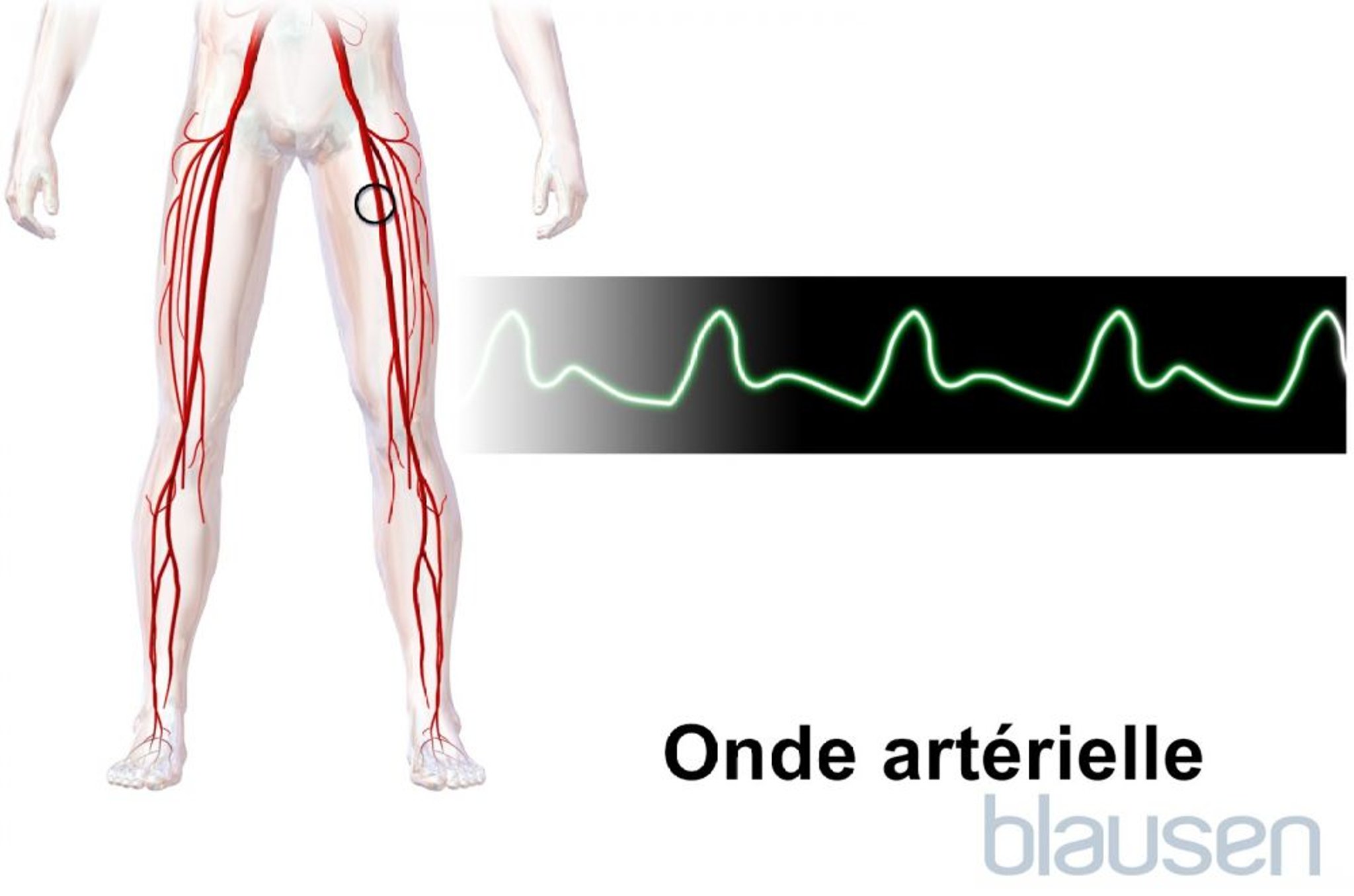 Forme d’onde artérielle