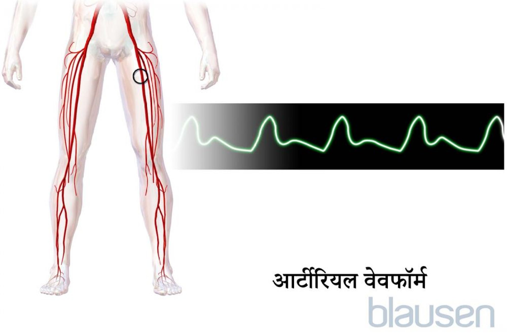 आर्टीरियल वेवफॉर्म