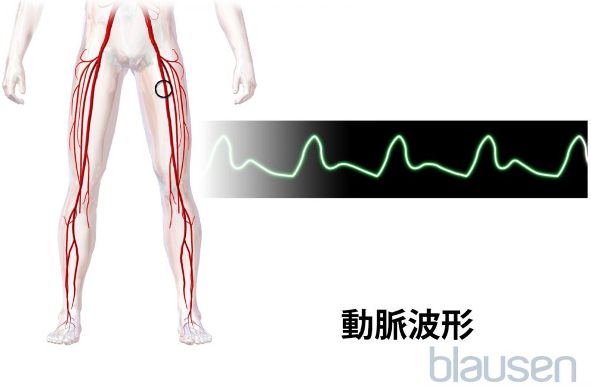 動脈波形