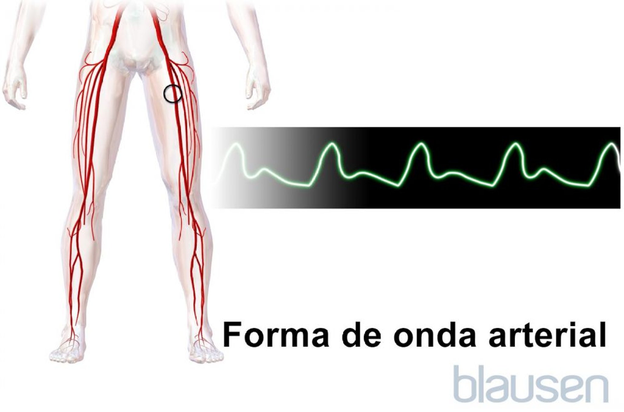 Forma de onda arterial