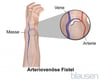 Arteriovenöse Fistel