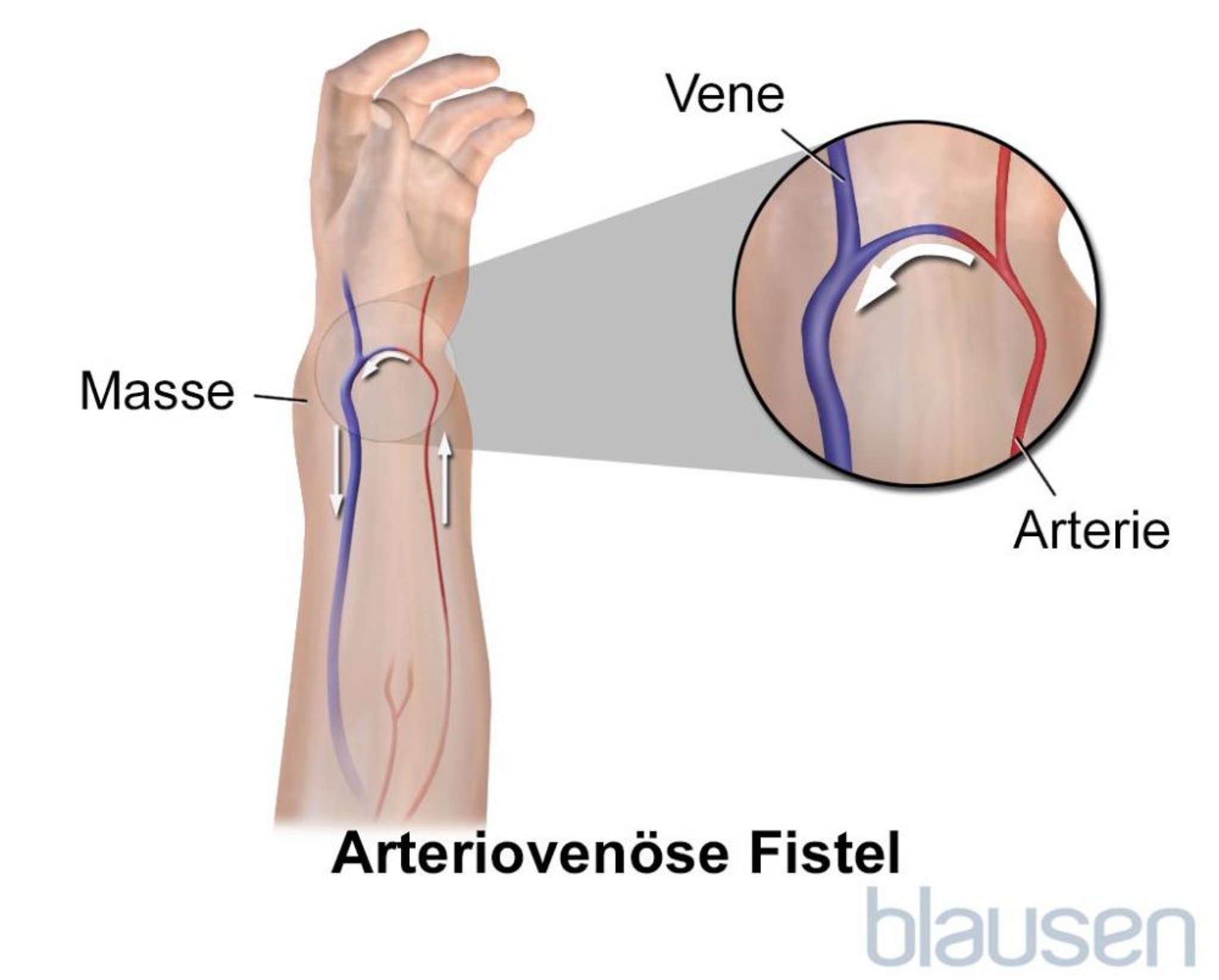 Arteriovenöse Fistel