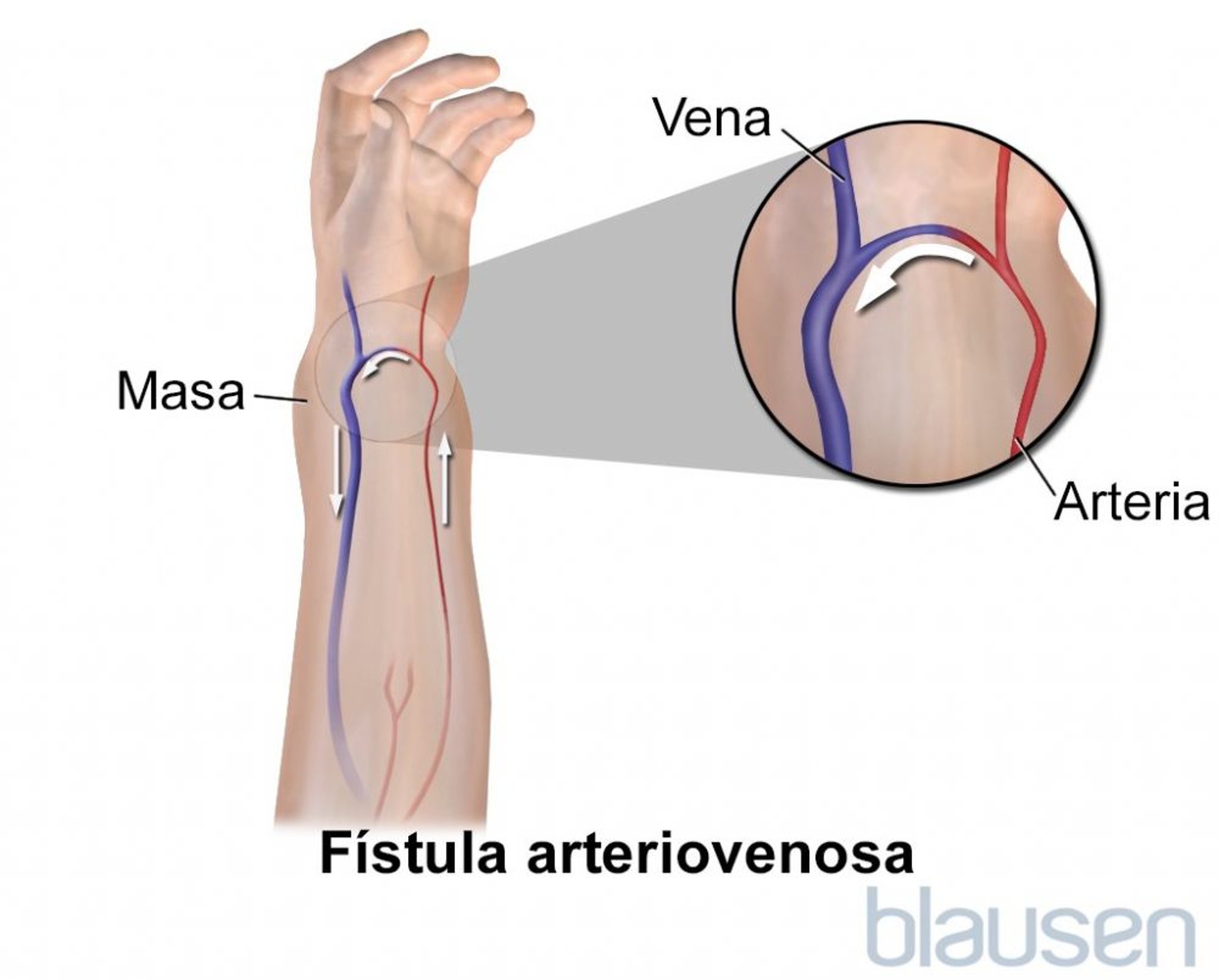 Fístula arteriovenosa