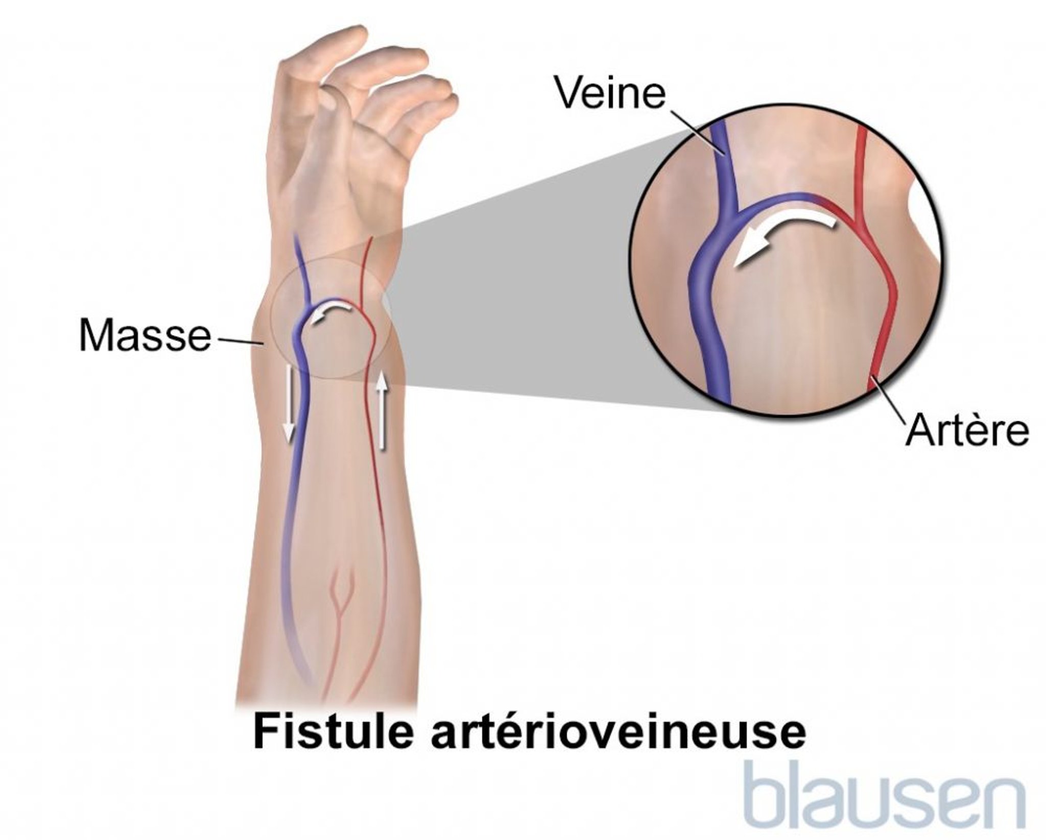 Fistule artério-veineuse
