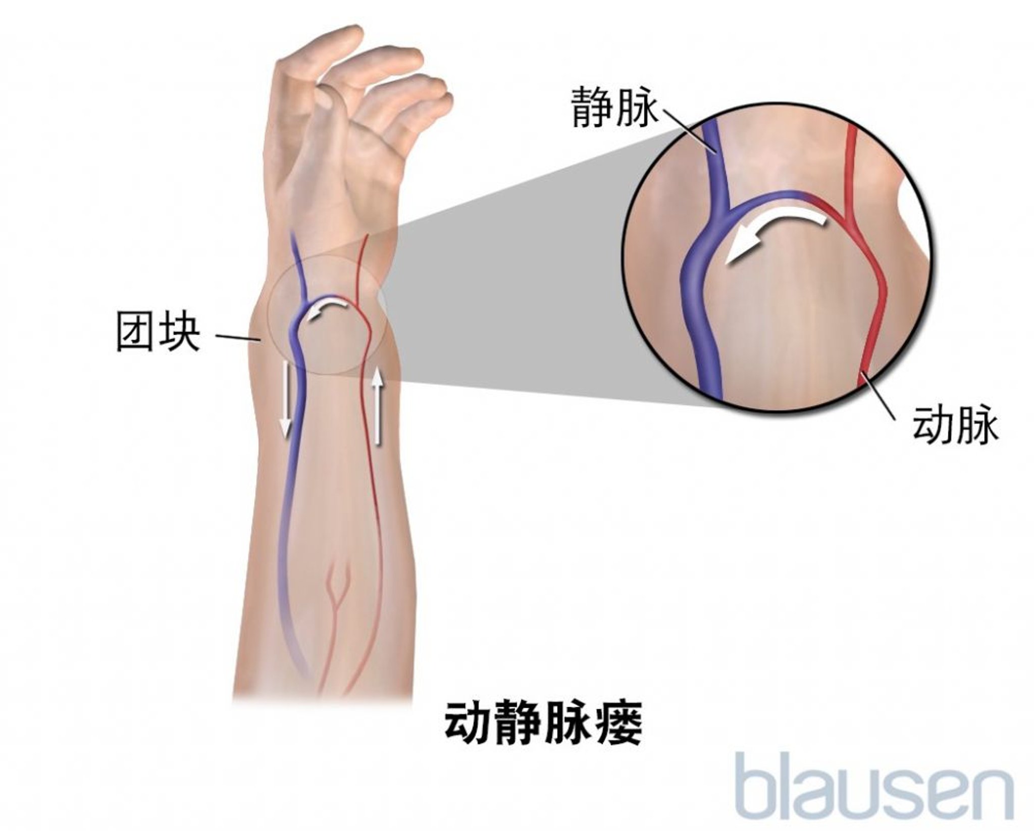 动静脉瘘