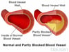 Normal Blood Vessel and Partially Blocked Blood Vessel
