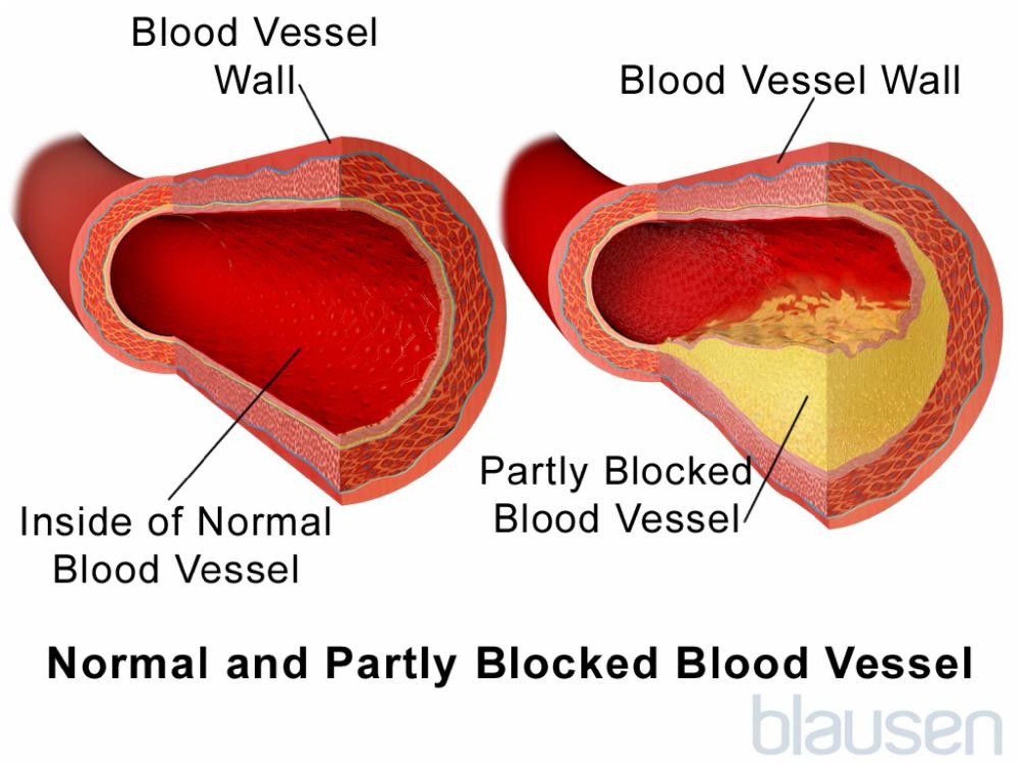 Normal Blood Vessel and Partially Blocked Blood Vessel