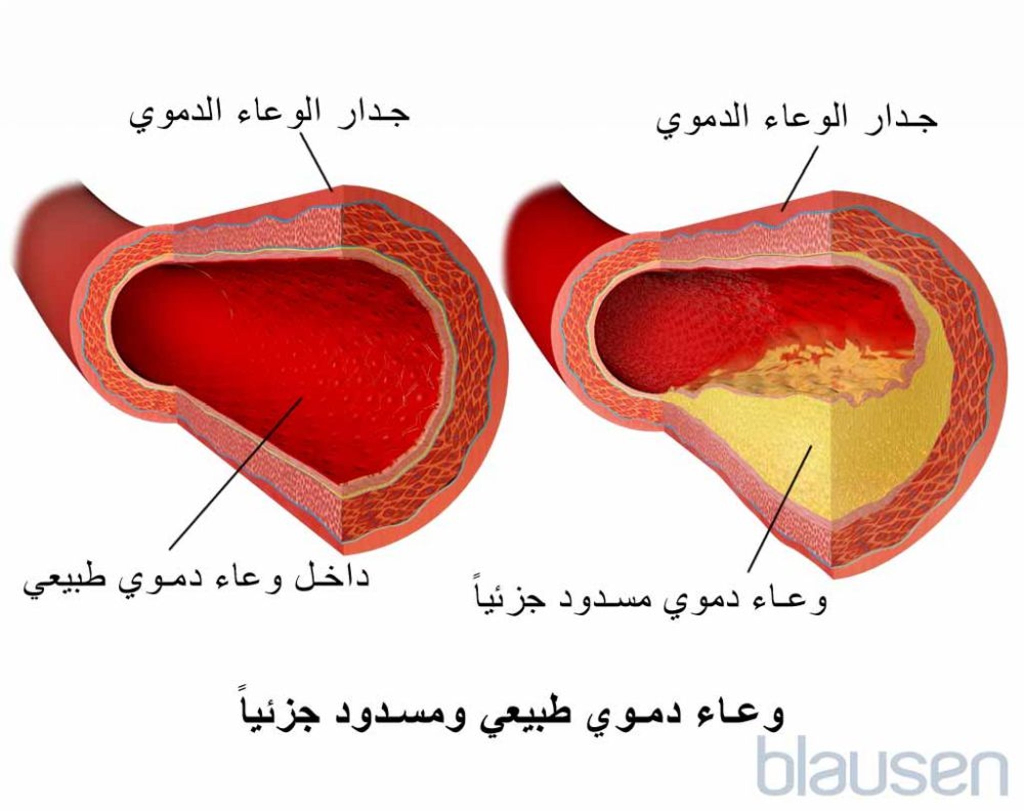 الوعاء الدموي الطبيعي والوعاء الدموي المسدود جزئيًا