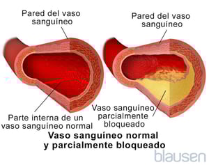 Vaso sanguíneo normal y vaso sanguíneo parcialmente obstruido
