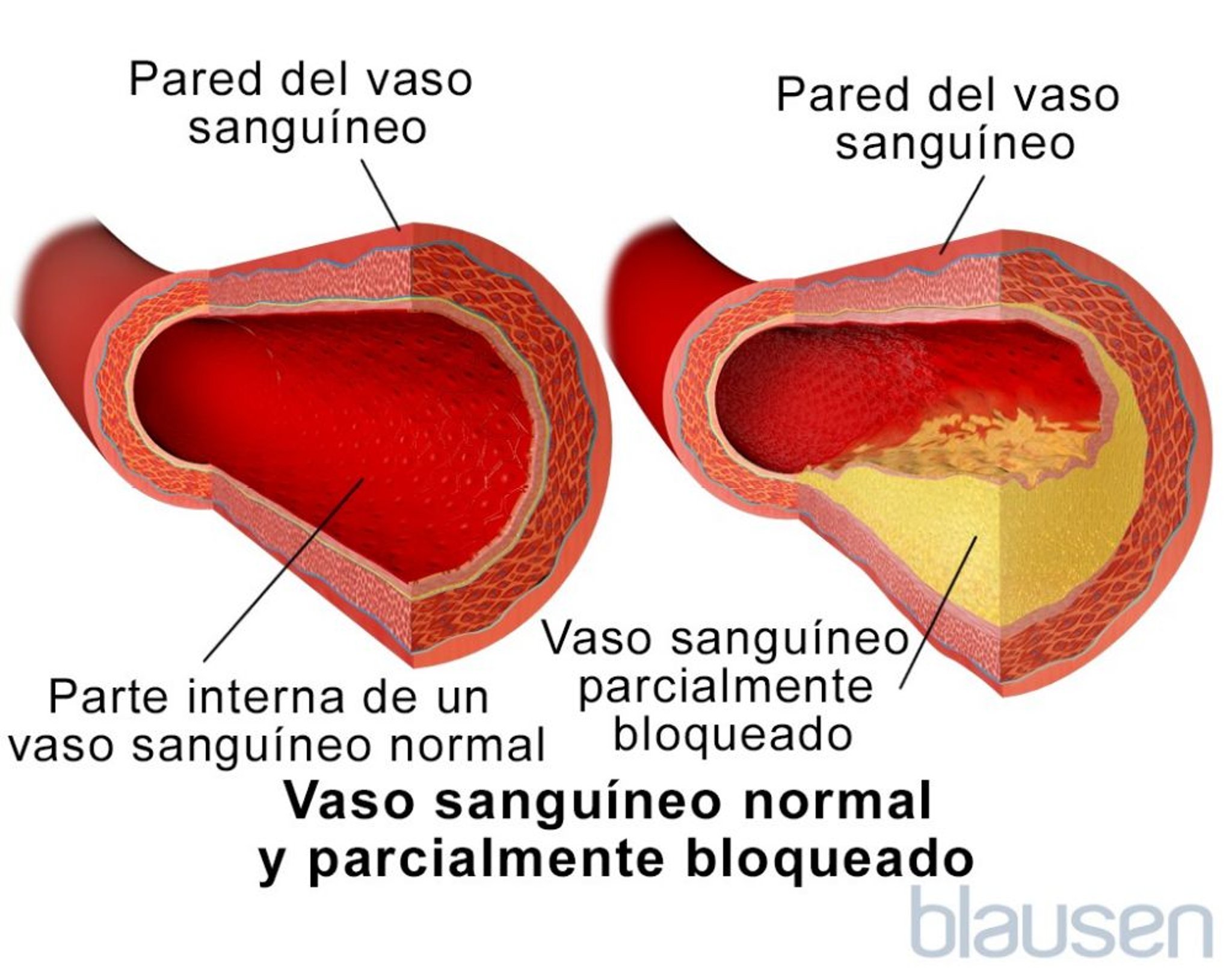 Vaso sanguíneo normal y vaso sanguíneo parcialmente obstruido