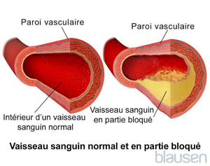 Vaisseau sanguin normal et vaisseau sanguin partiellement obstrué