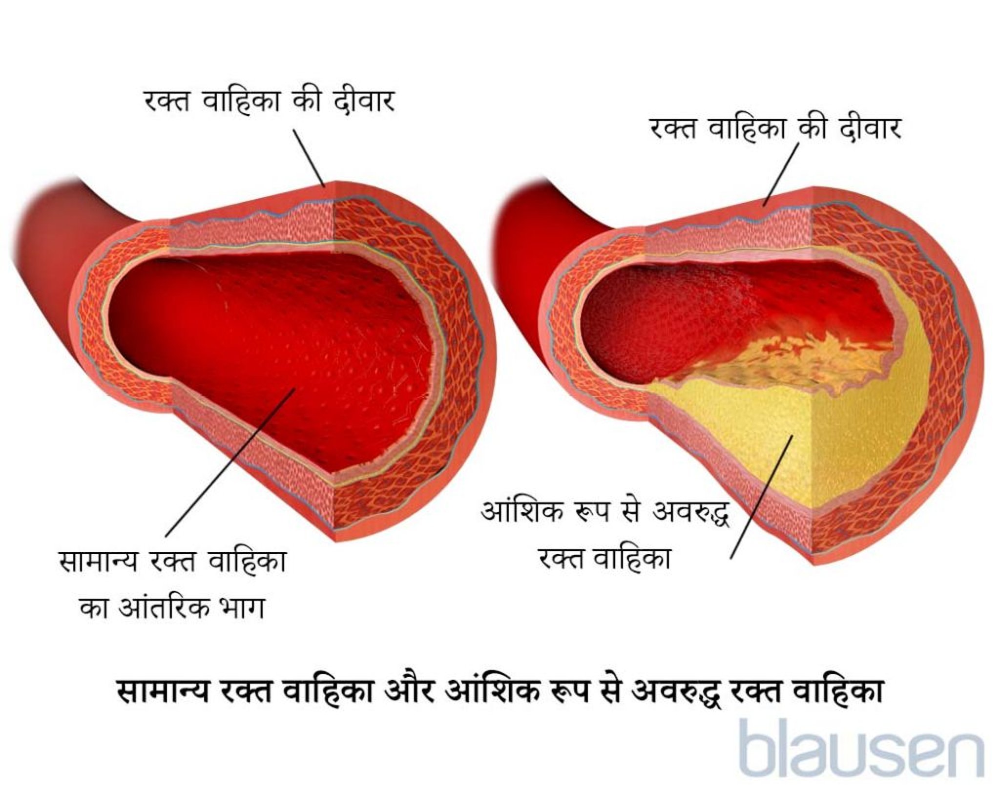 सामान्य रक्त की धमनी और आंशिक रूप से अवरुद्ध रक्त की धमनी