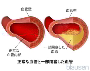 正常せいじょうな血管けっかんと部分的ぶぶんてきに閉塞へいそくした血管けっかん