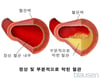 정상 혈관 및 부분적으로 막힌 혈관