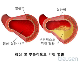 정상 혈관 및 부분적으로 막힌 혈관