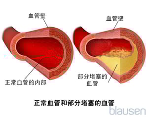 正常血管和部分阻塞的血管