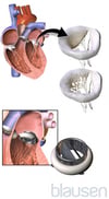 Artificial Heart Valve