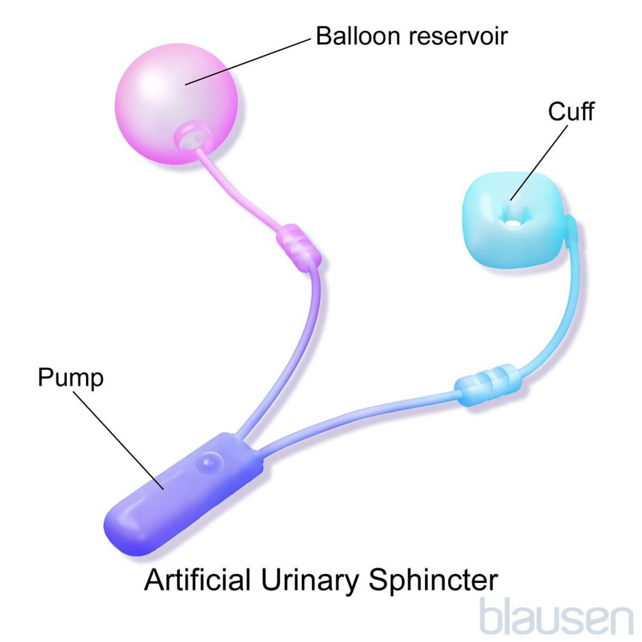 Artificial Urinary Sphincter