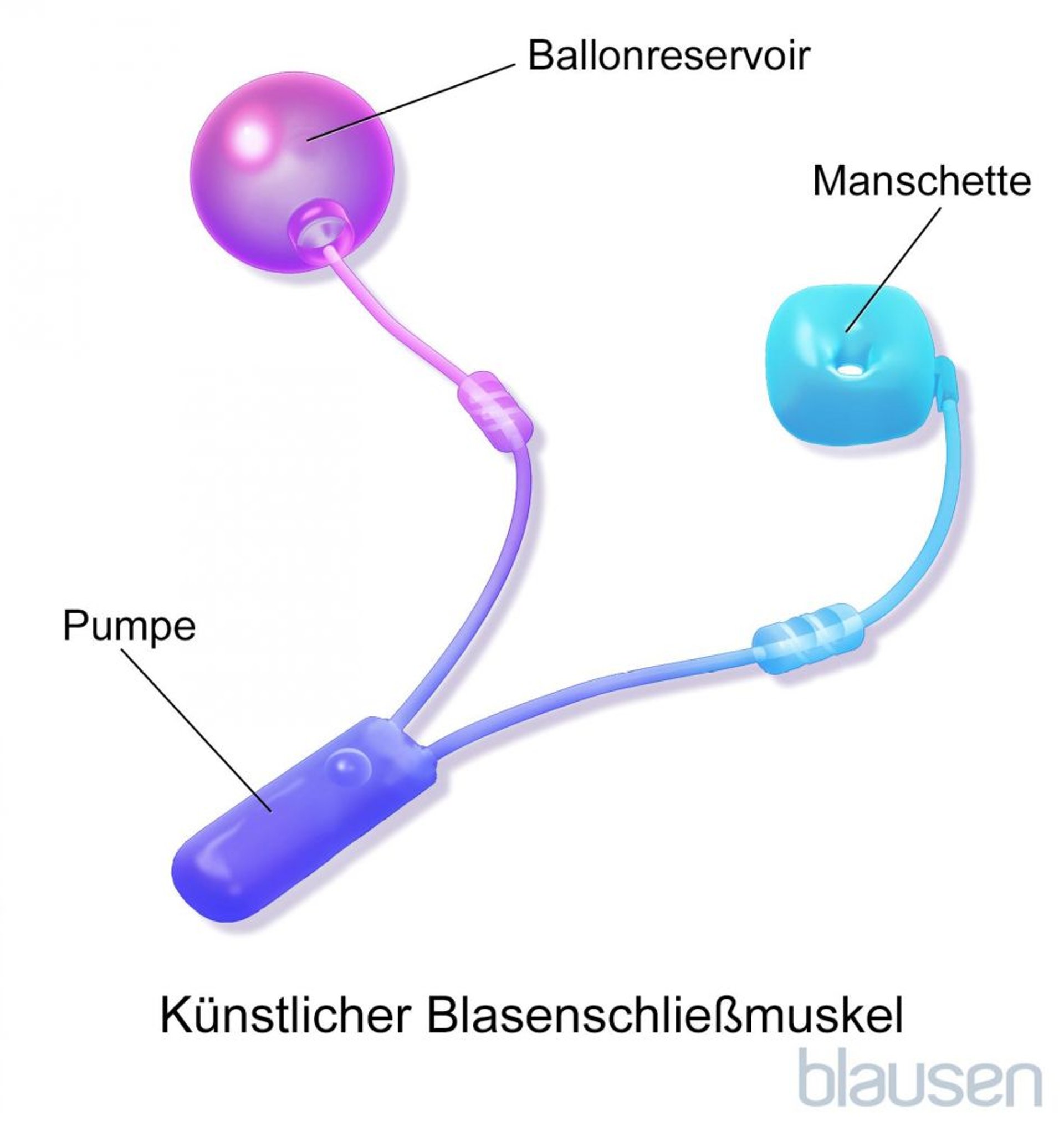 Künstlicher Blasenschließmuskel