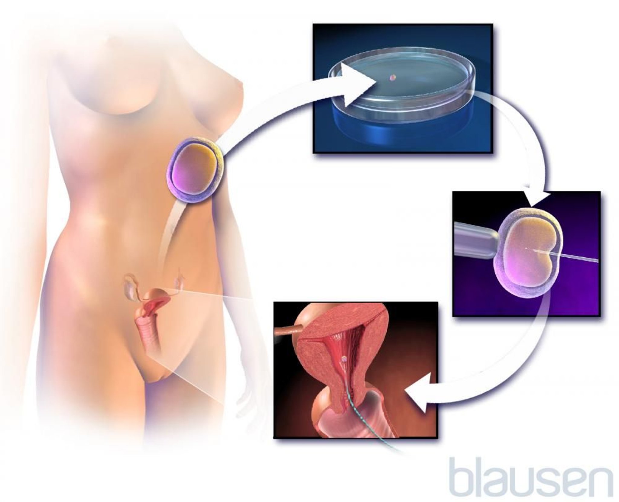 In-vitro-Fertilisation mit intrazytoplasmatischer Spermieninjektion