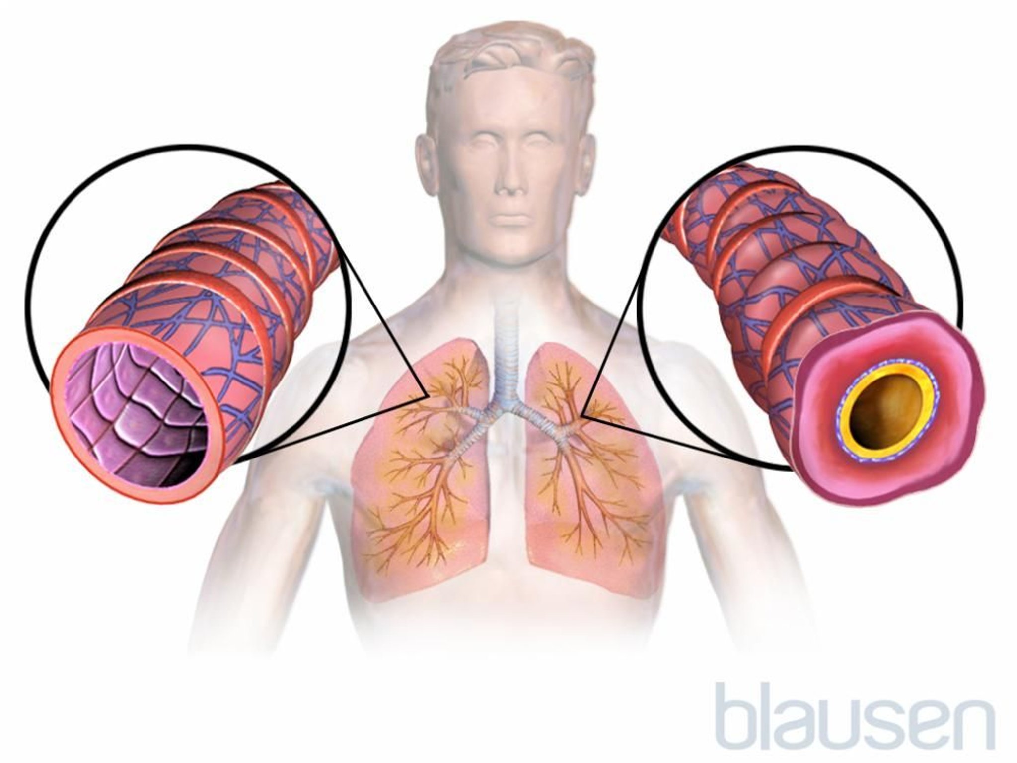 Asthme