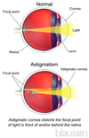 Astigmatism