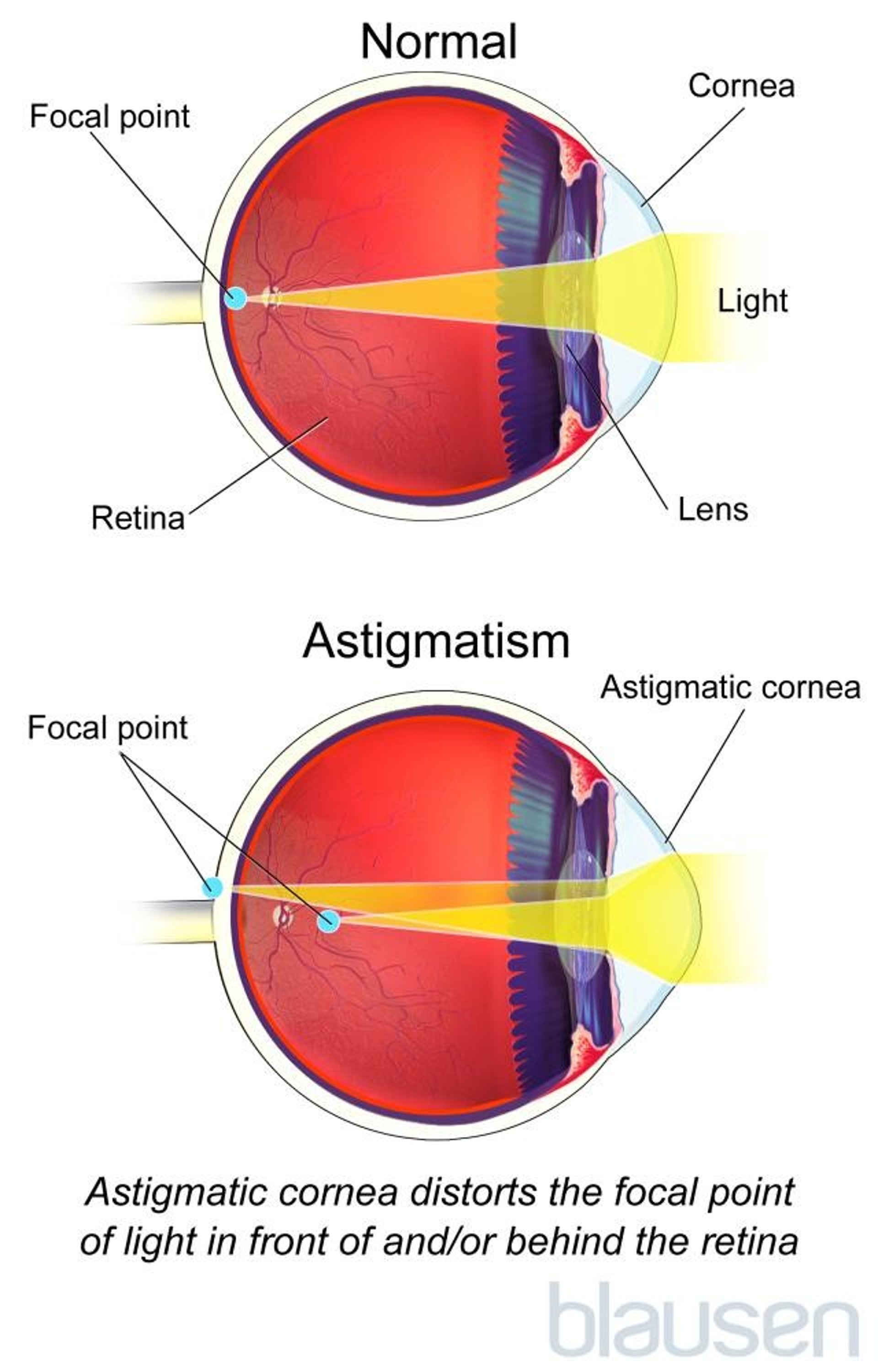 Astigmatism