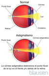 Astigmatismo