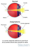 Astigmatisme