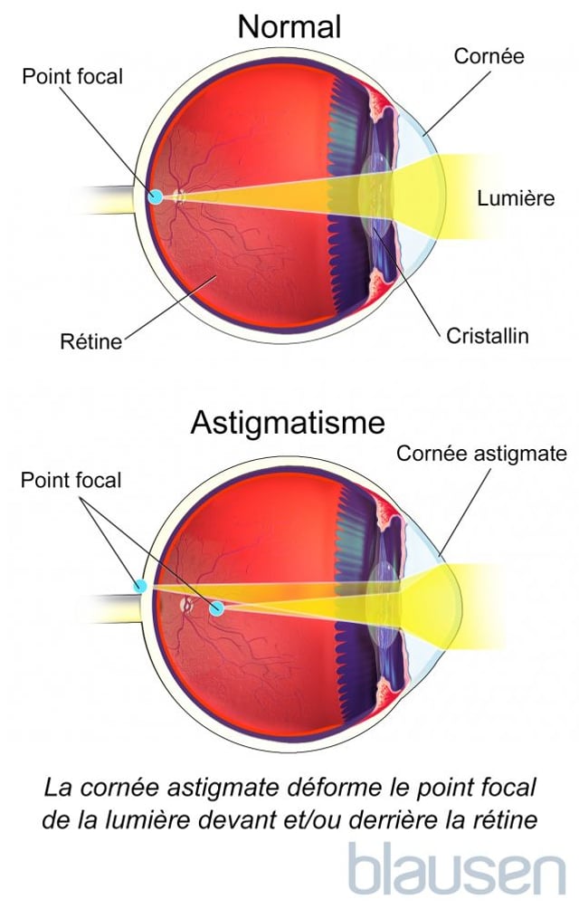 Vision floue Vision floue Manuels MSD pour le grand public