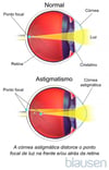 Astigmatismo