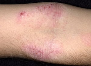 Dermatitis atópica (crónica)