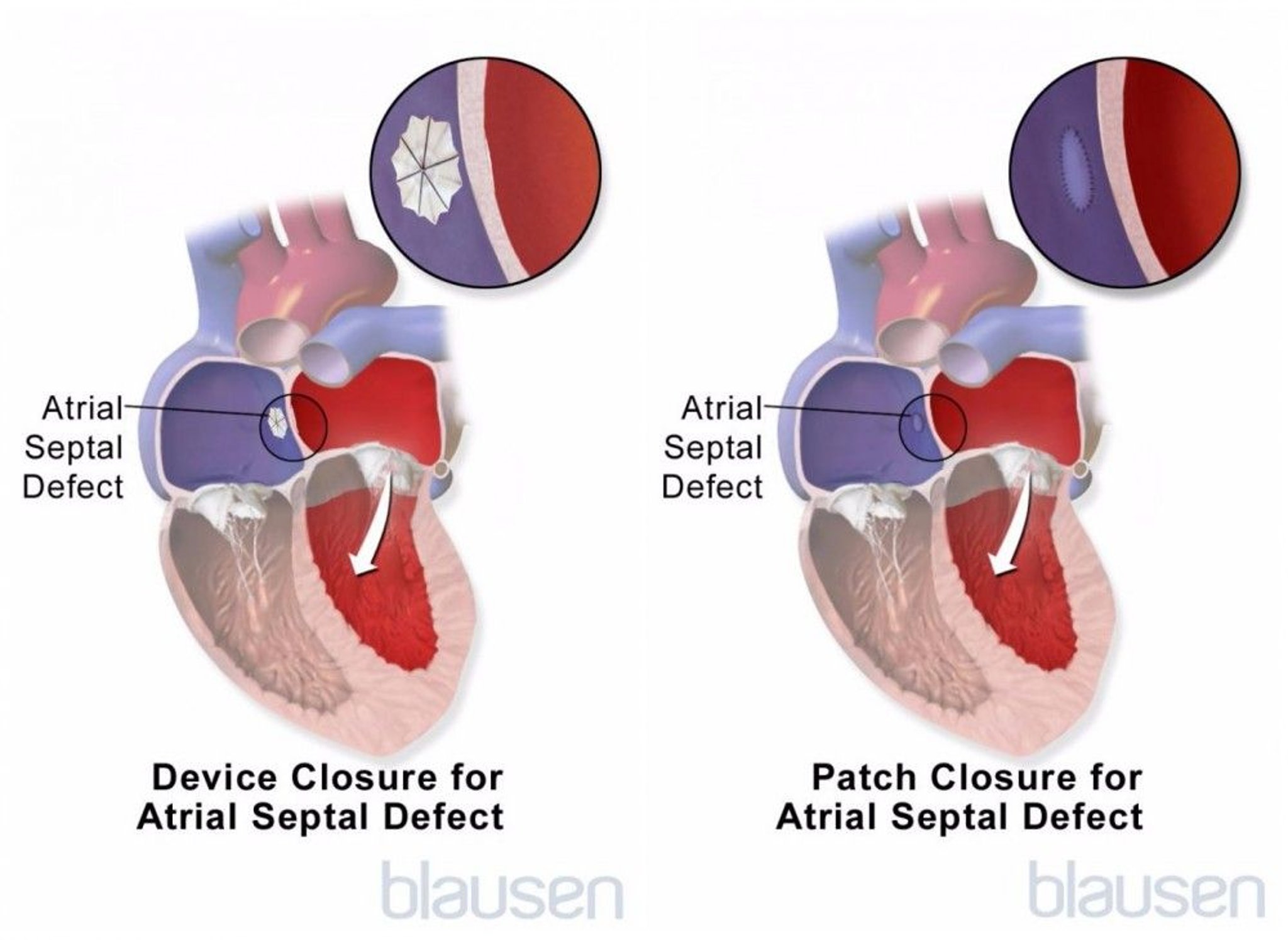 Atrial Septal Defect Repair