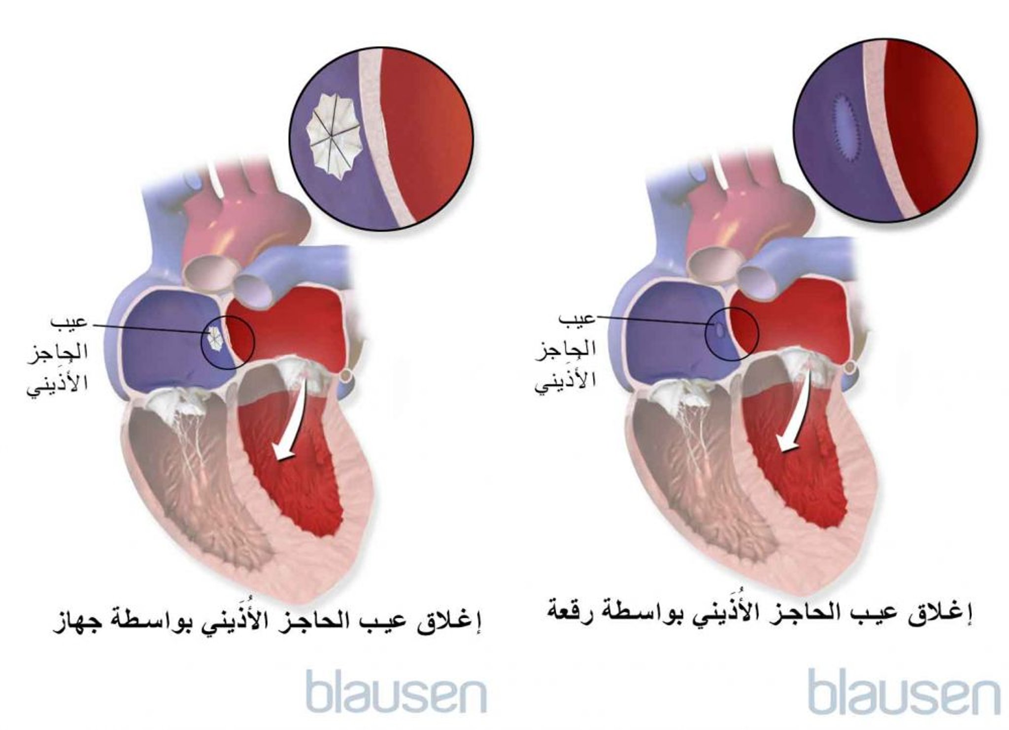 تصحيح عيوبُ الحاجز الأذيني