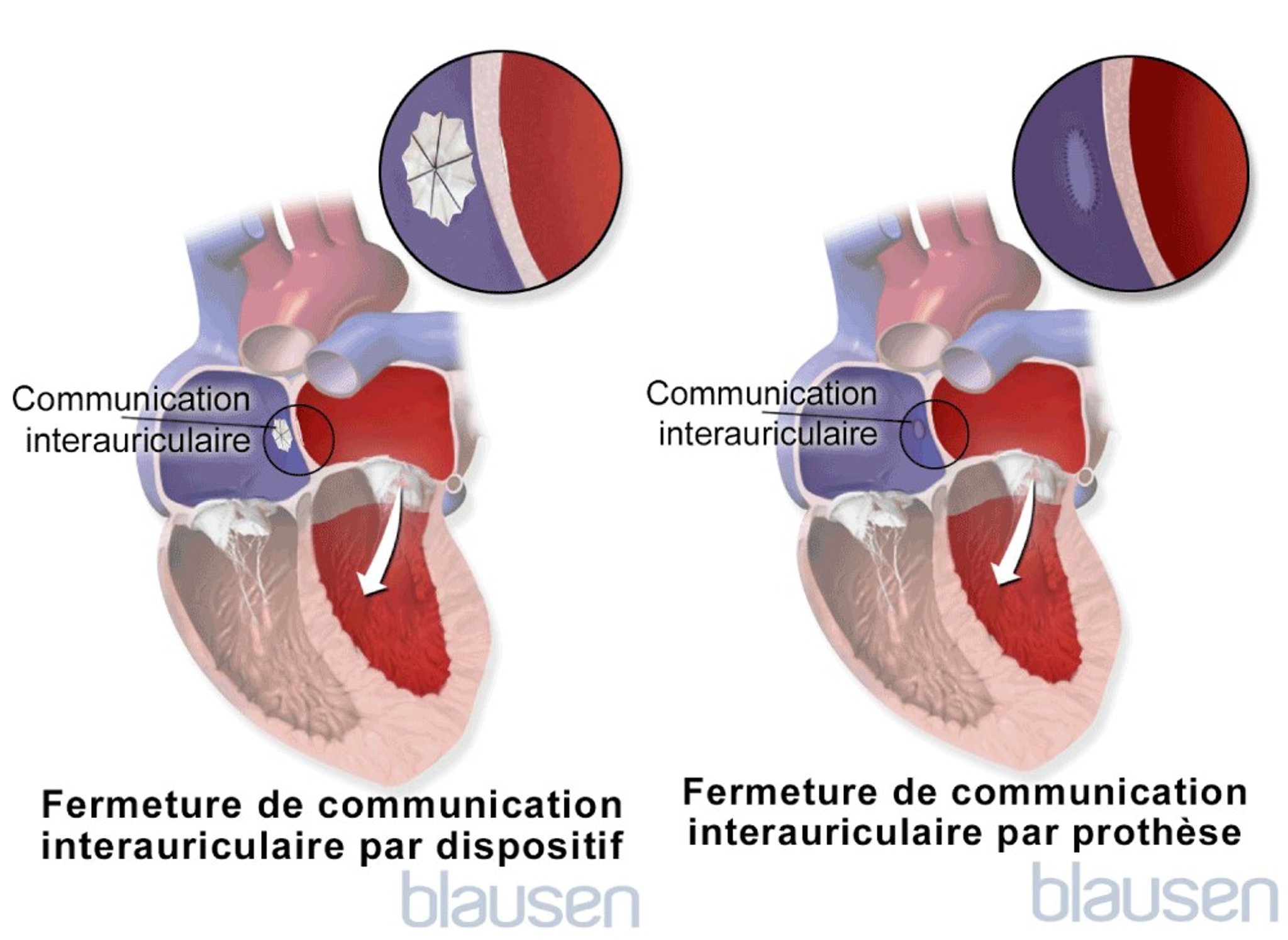 Réparation d’une communication interauriculaire
