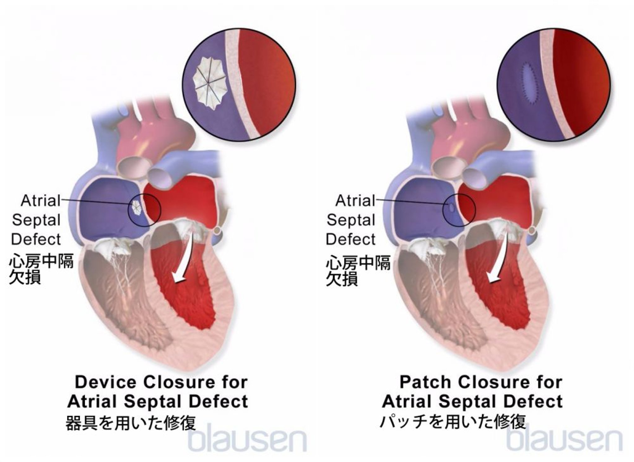 心房中隔欠損症の修復
