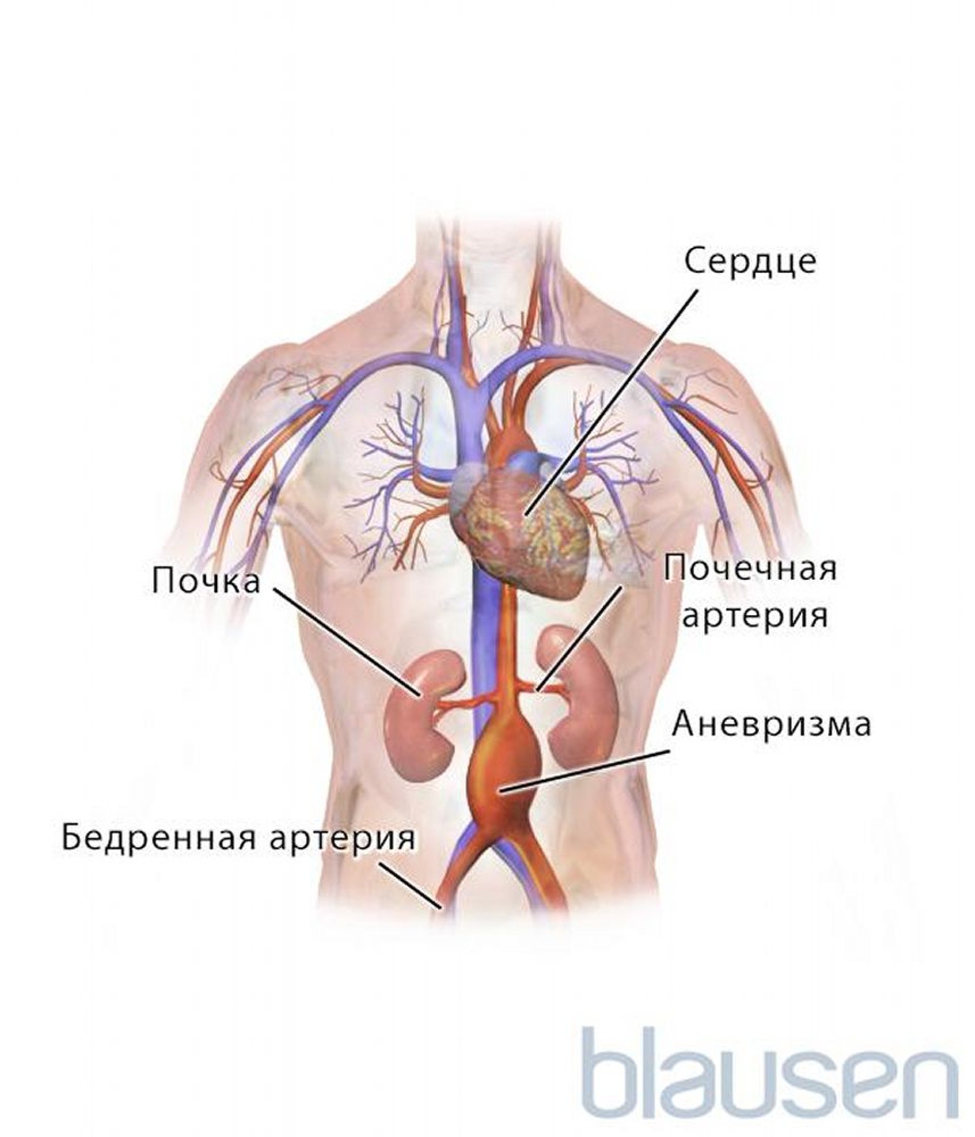 Аневризма брюшной аорты