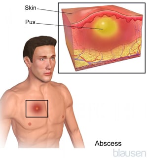 Абсцесс кожи