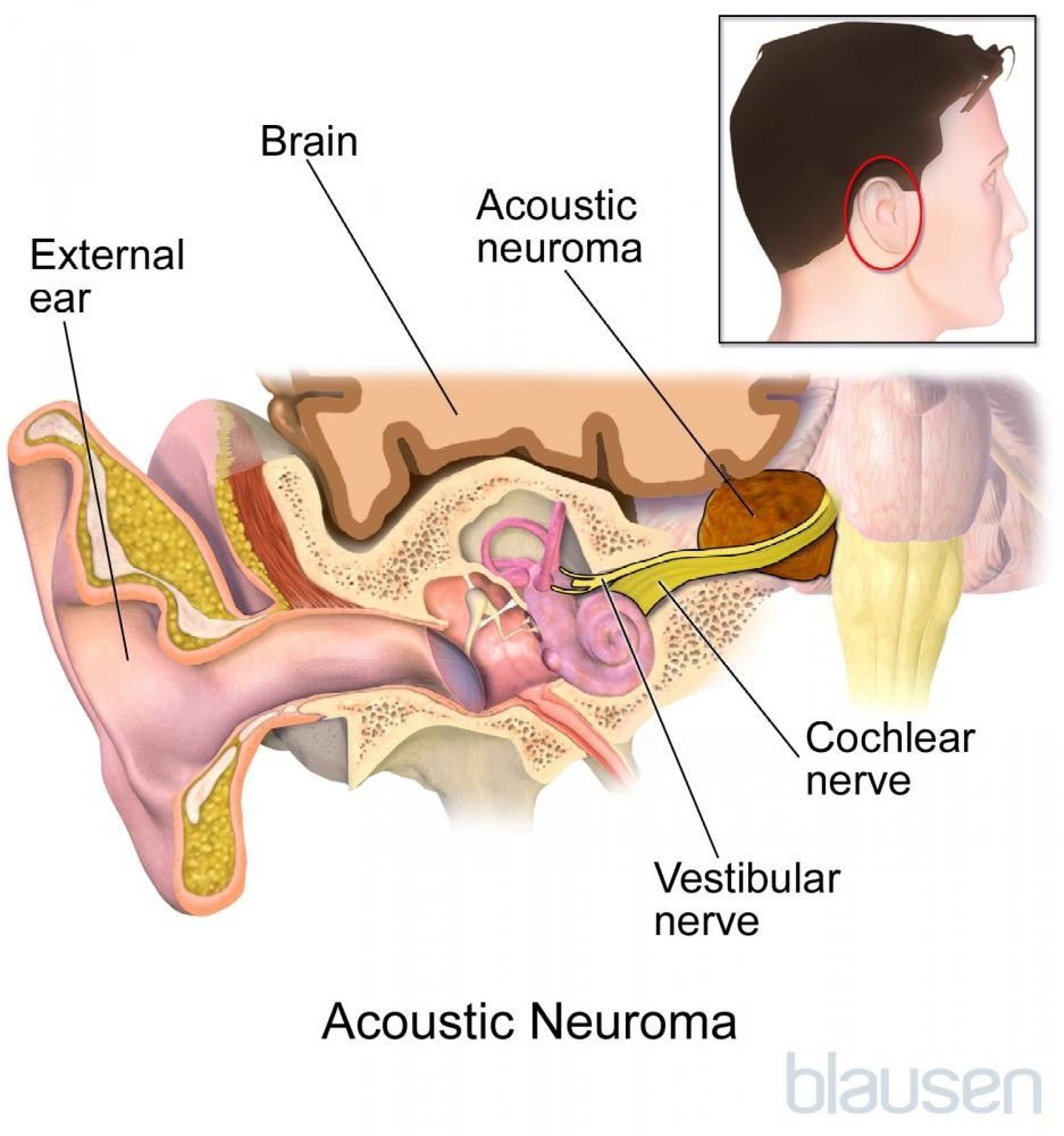 Vestibular Schwannoma (Neuroma Akustik)