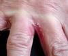 Allergic Contact Dermatitis (2)