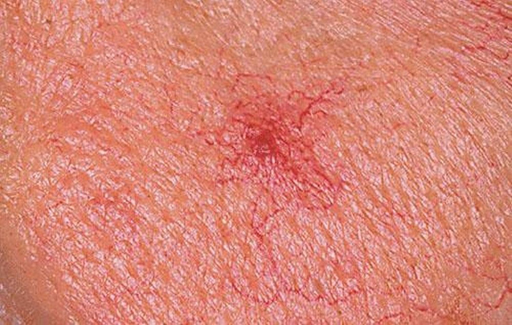 Angioma za Buibui