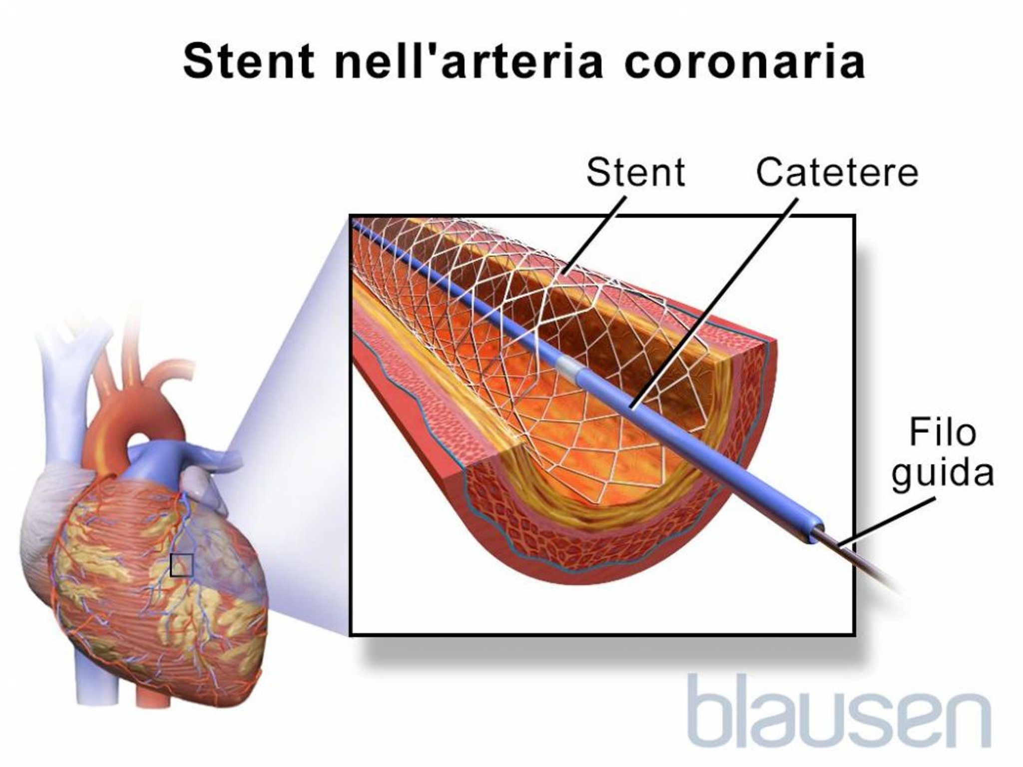 Angioplastica con stent
