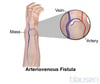 Atresia na Fistula
