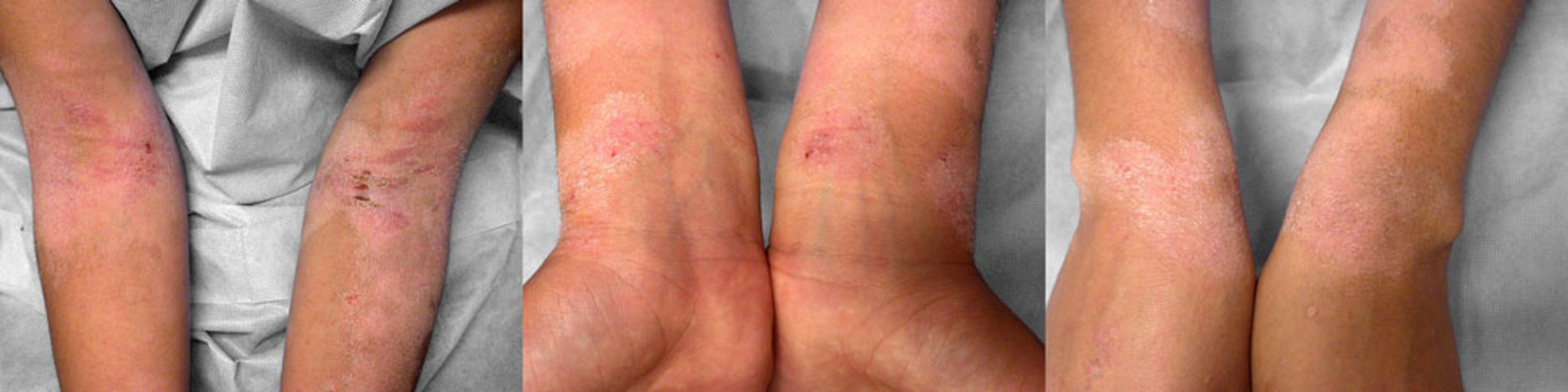 Atopic Dermatitis (Flexural Areas) (1)