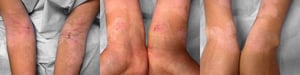 Atopic Dermatitis (Flexural Areas) (1)