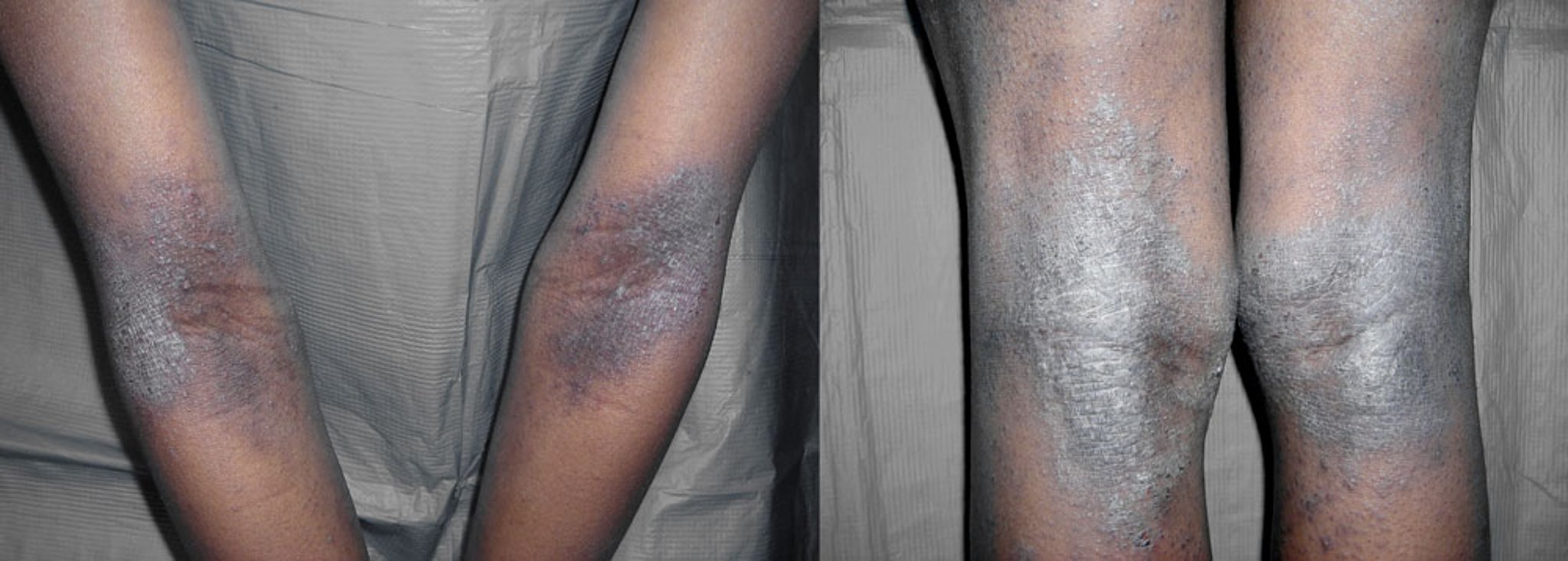 Atopic Dermatitis (Flexural Areas) (2)