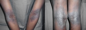 Atopic Dermatitis (Flexural Areas) (2)