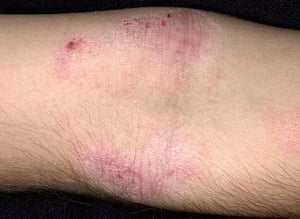 Dermatite atopica (cronica)