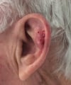 Atypical Fibroxanthoma